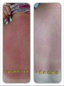 脸晒伤图片,晒伤脸部的急救与护理